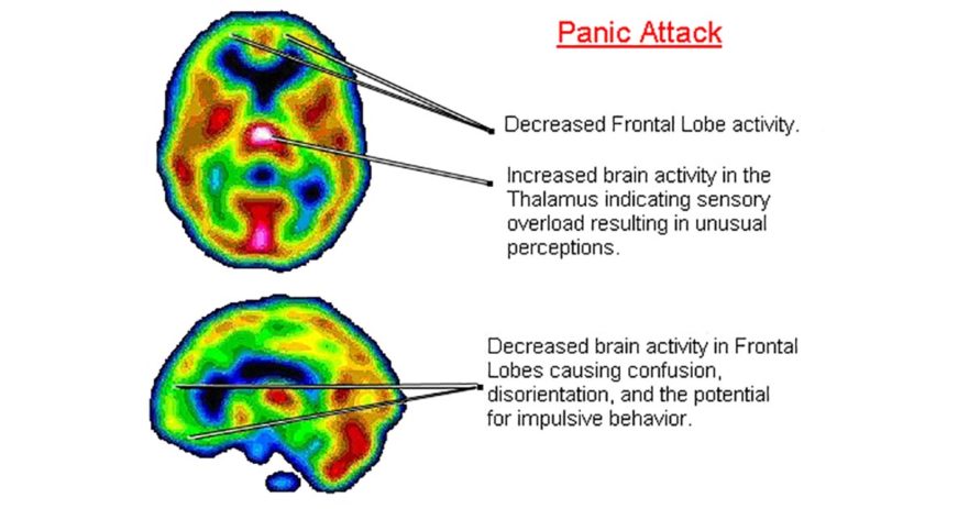 Panic attack brain