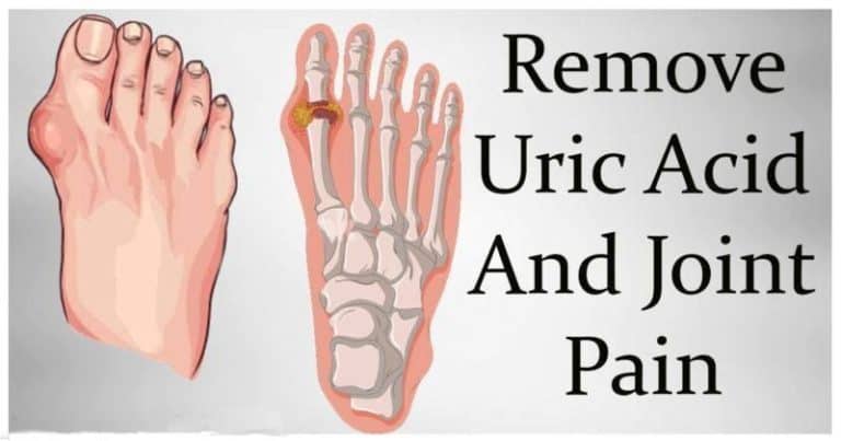How To Remove Gout and Joint Pain (Uric Acid and Crystals)