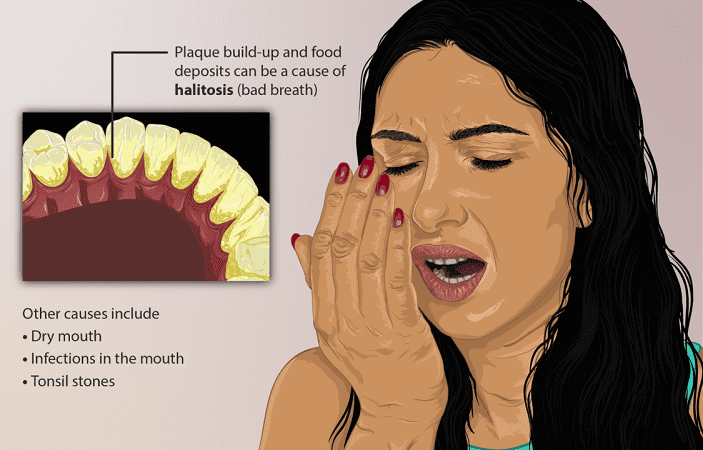 what is halitosis - a female person who has halitosis (bad breath)
