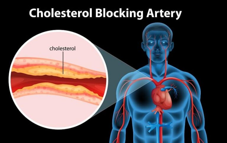 Is High Cholesterol and Heart Disease Myth or Truth? Here’s why lowering your cholesterol will cause heart disease.
