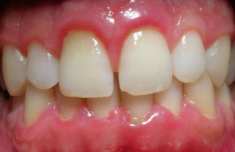 What Is Periodontal Disease and How Is It Treated?