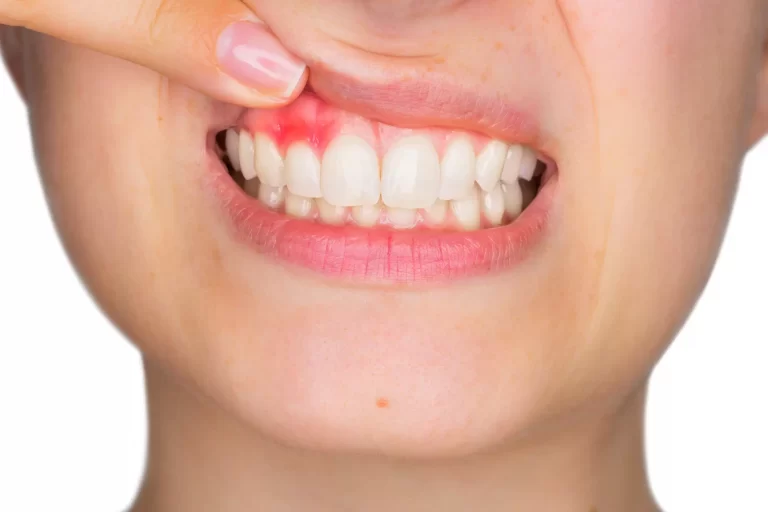 The Relationship between Vitamin C And Bleeding Gums