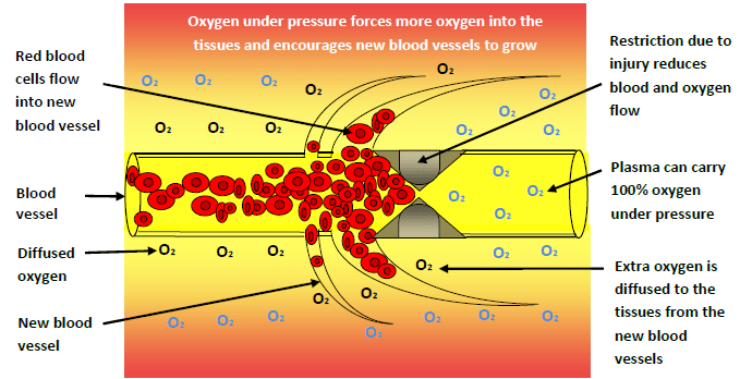 Illustration on how oxygen under pressure forces more oxygen into the tissues and encourages new blood vessels to grow.