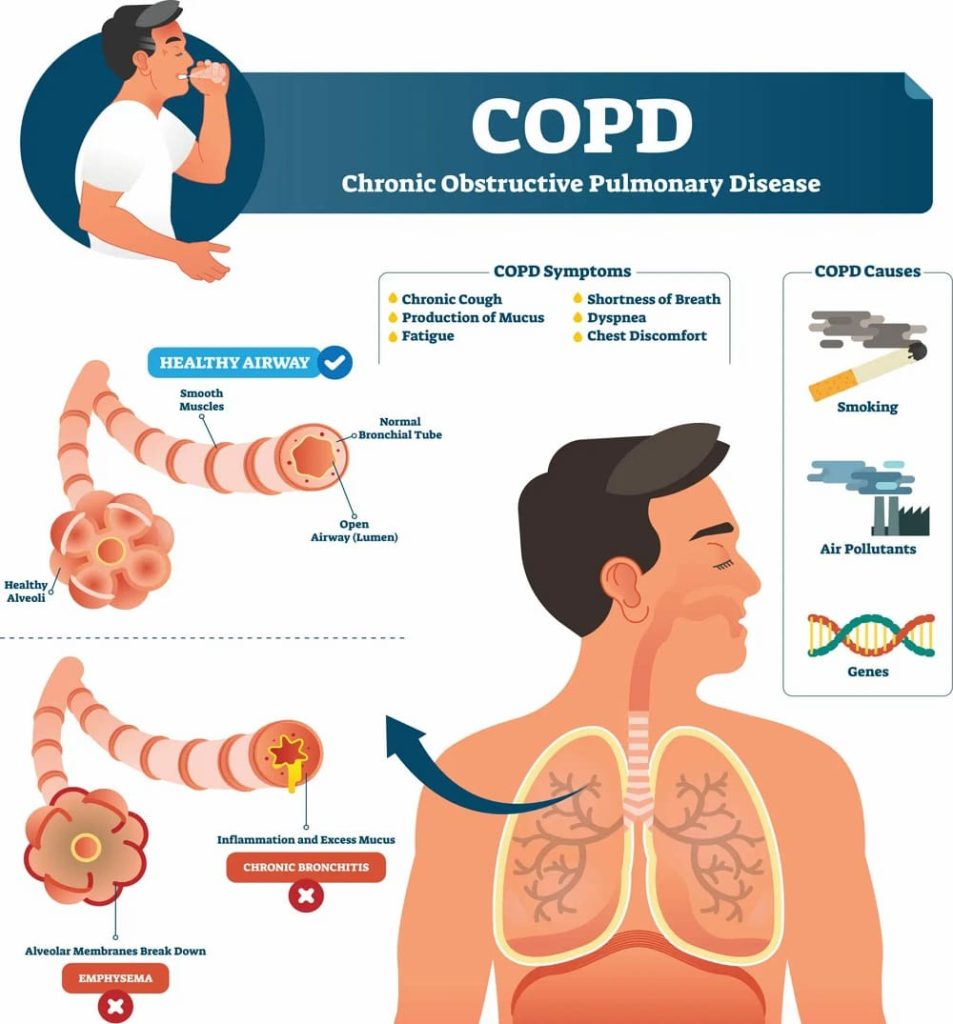 Hyperbaric Oxygen Therapy for COPD